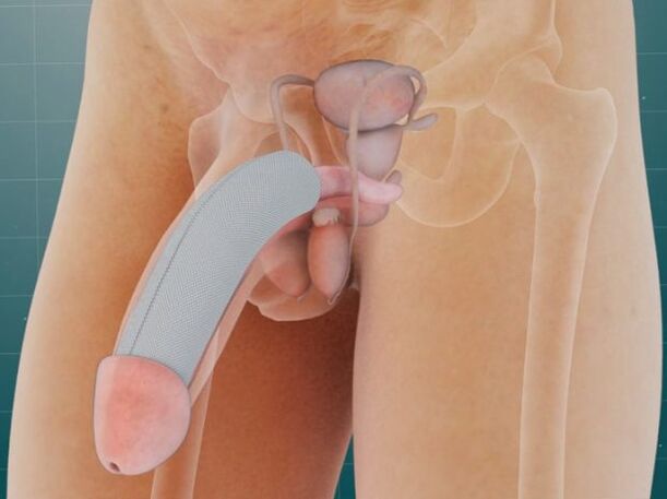 After insertion of the penis, a special implant is placed under the skin