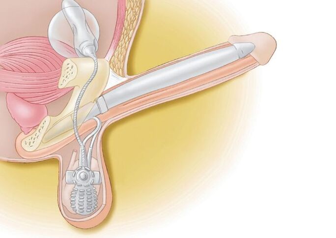 penile prostheses for enlargement